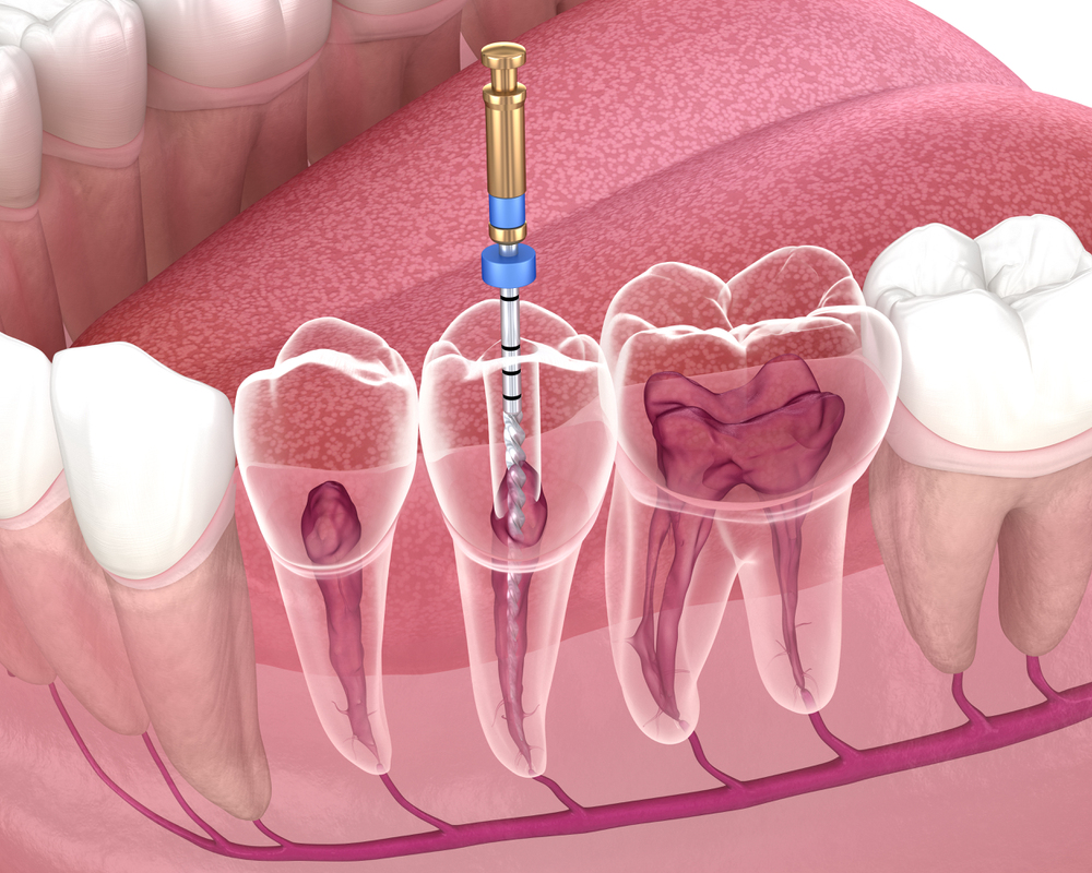 Root Canal Treatment